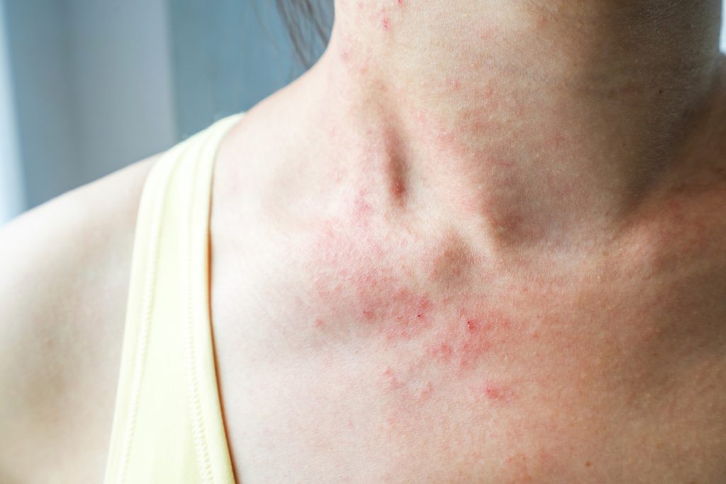 eczema skin